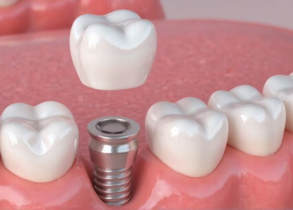 implantes contacto